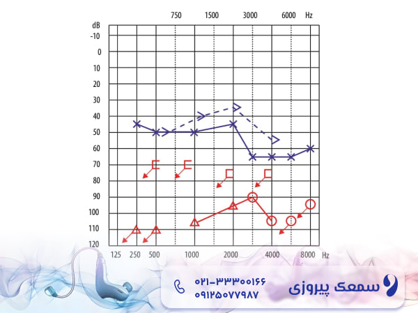 تشخیص کم شنوایی حسی عصبی